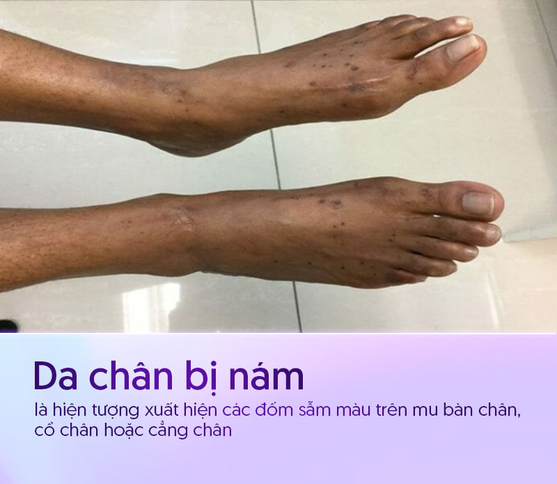 da chân bị nám