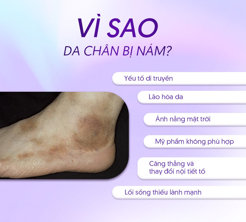 ngyên nhân da chân bị nám
