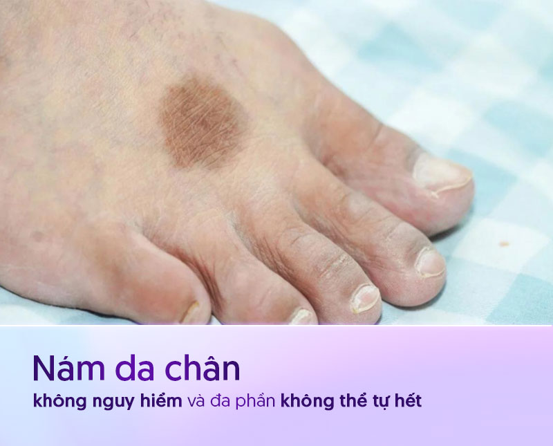 nám da chân không tự hết