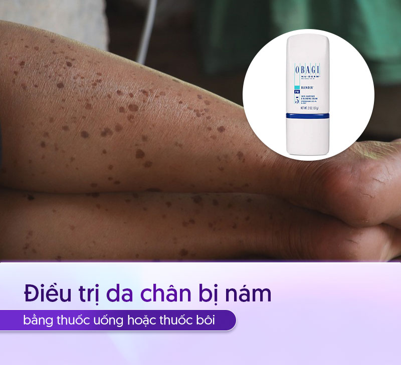điều trị da chân bị nám