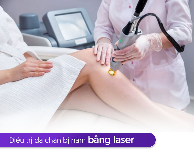 công nghệ laser trị nám da chân