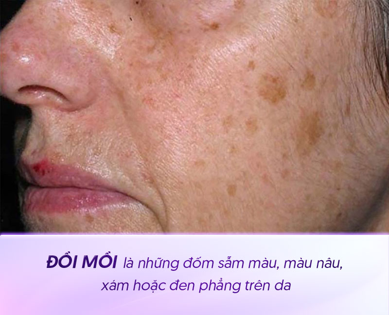 Đốm đồi mồi là gì