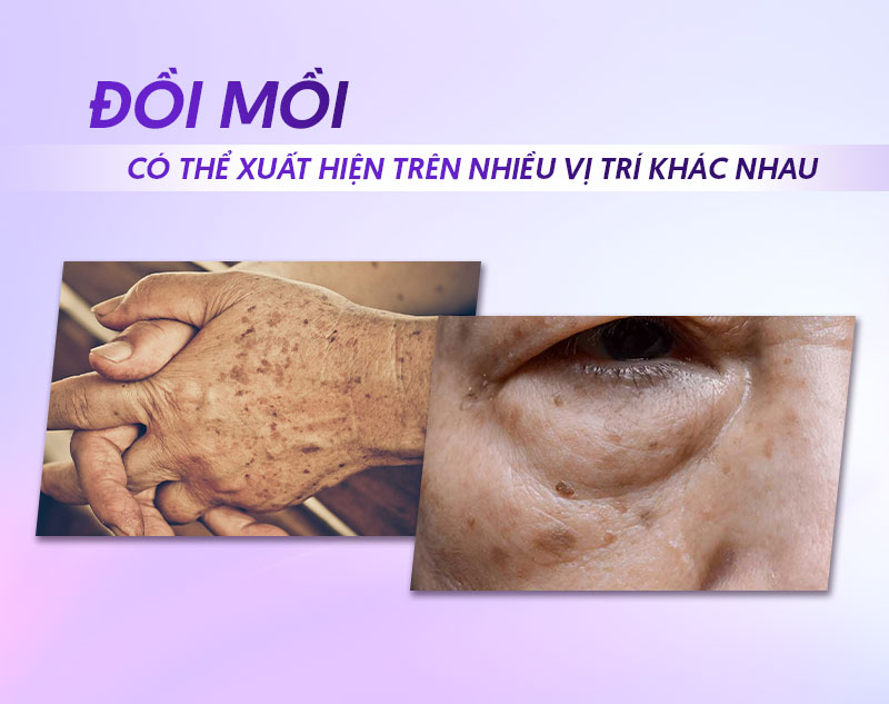 Dấu hiệu nhận biết đốm đồi mồi
