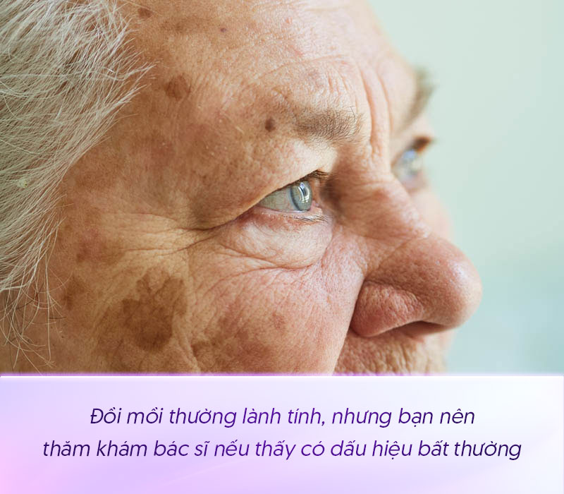 Đốm đồi mồi có sức khỏe không