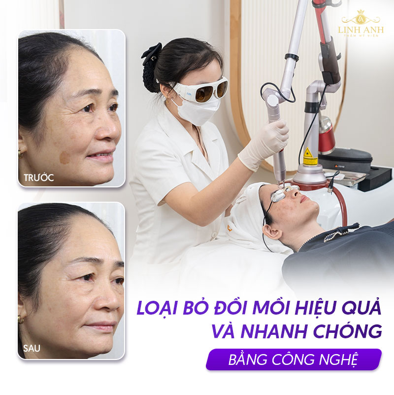 Điều trị đốm đồi mồi bằng công nghệ cao