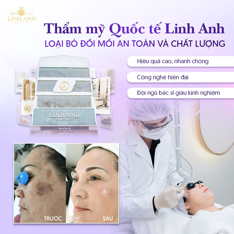 Điều trị đốm đồi mồi tại Linh Anh