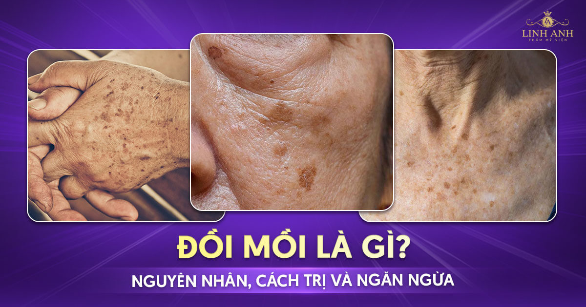 Đồi mồi là gì? Nguyên nhân, cách trị và ngăn ngừa hiệu quả