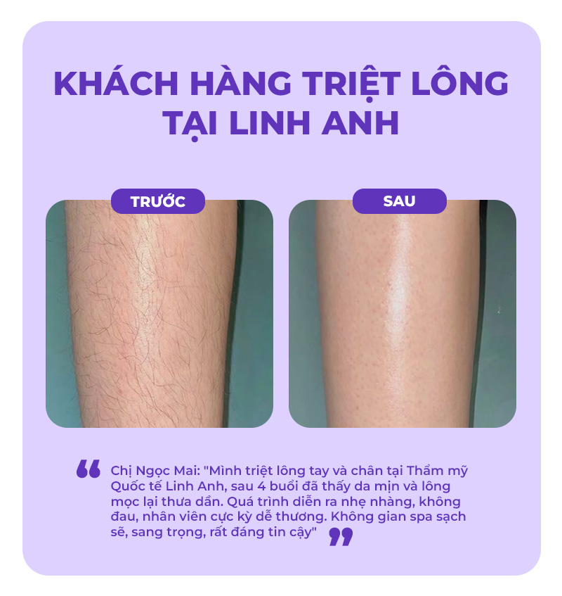 feedback sau triệt long tại Linh Anh feedback sau triệt long tại Linh Anh