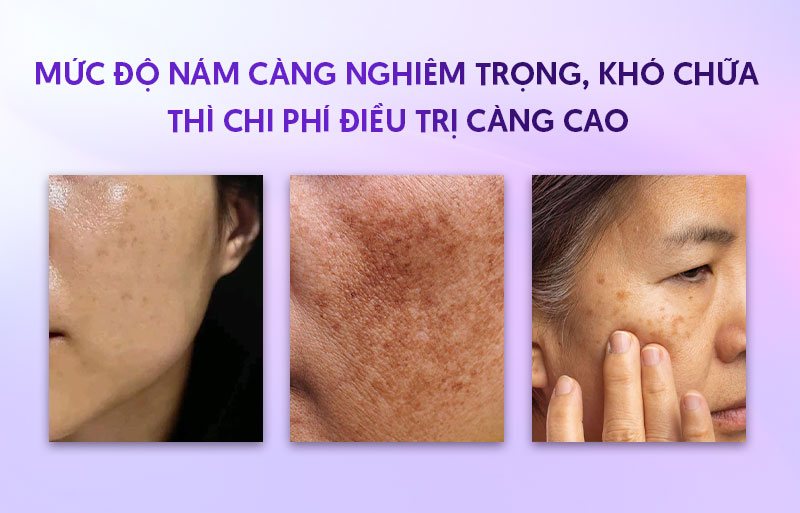 Liệu trình trị nám giá bao nhiêu tùy mức độ nám