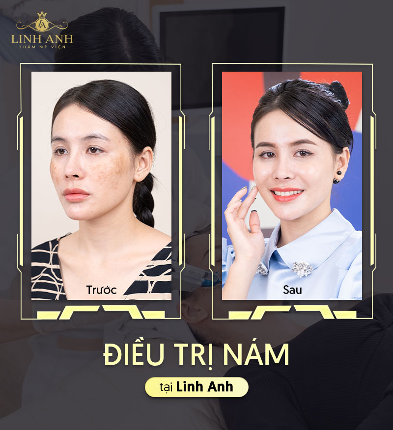 Điều trị nám tại Linh Anh