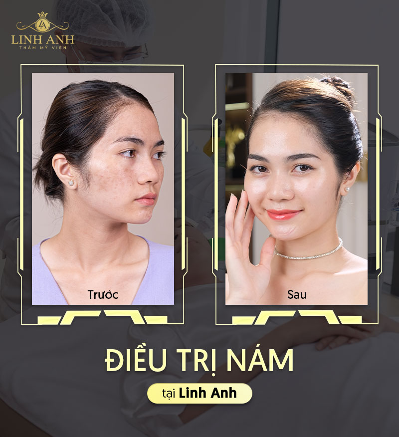 Hiệu quả khi điều trị nám tại Linh Anh