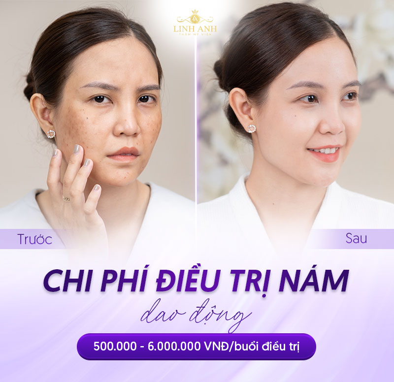 liệu trình trị nám giá bao nhiêu liệu trình trị nám giá bao nhiêu