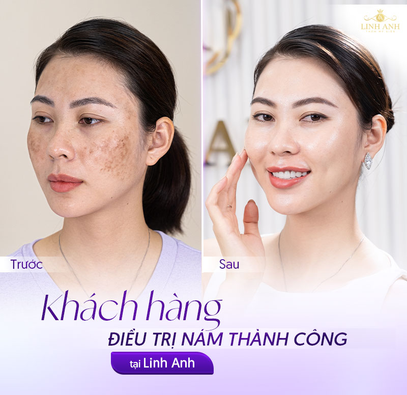 khách hàng điều trị nám thành công