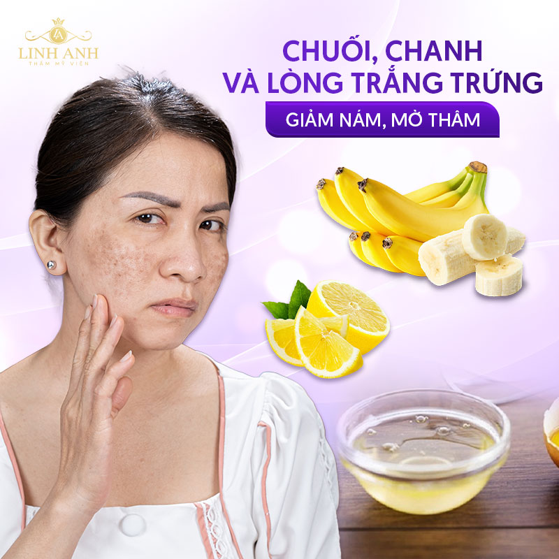 chuối kết hợp lòng trắng trứng giúp giảm nám