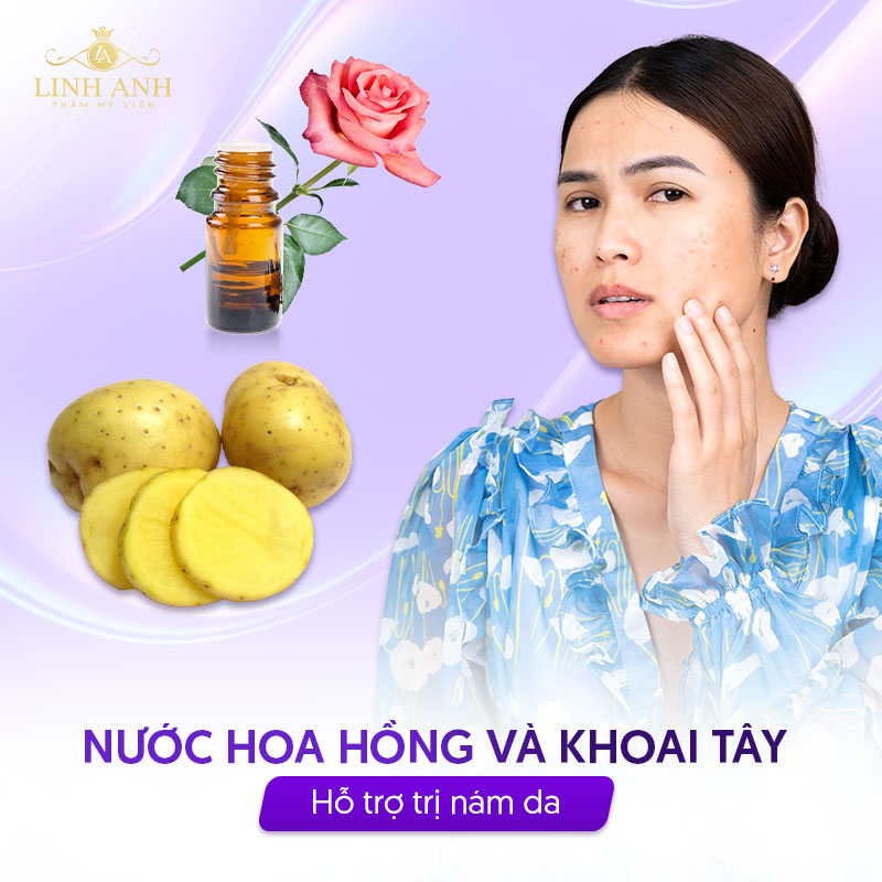 Trị nám với khoai tây và nước hoa hồng