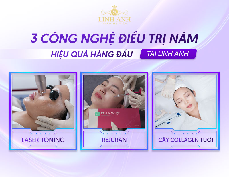 Điều trị nám bằng công nghệ cao