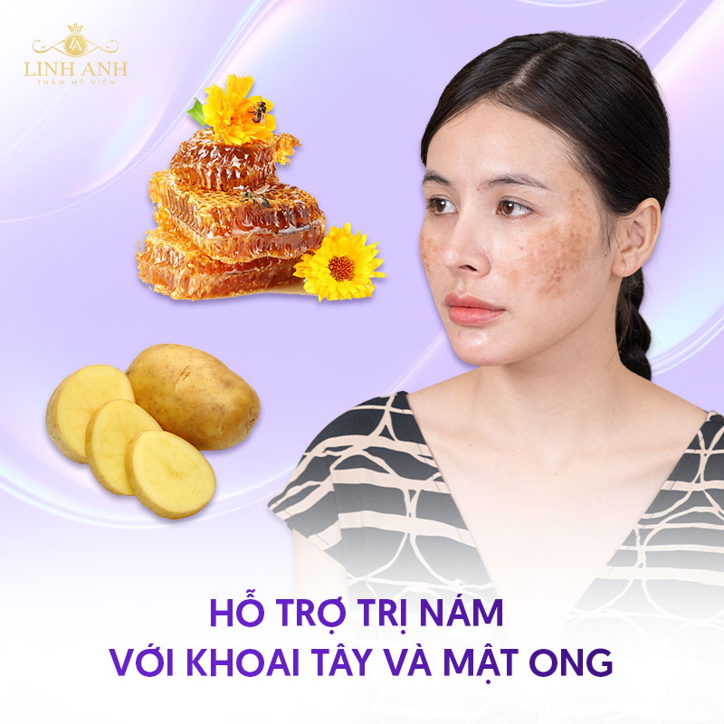 Trị nám bằng mật ong và khoai tây