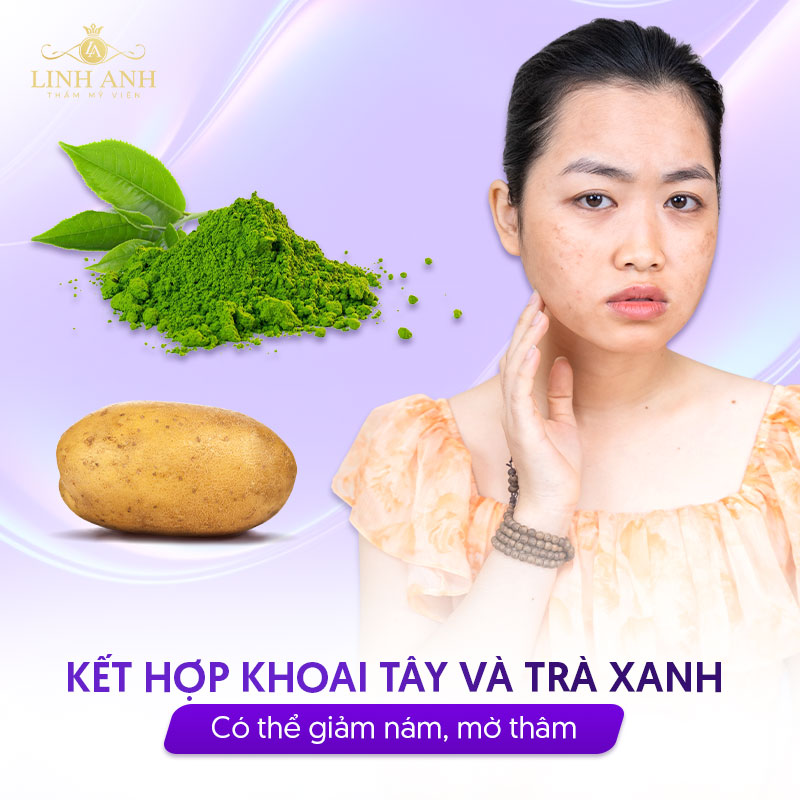 Trị nám với khoai tây và trà xanh