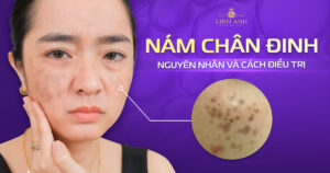 nám chân đinh