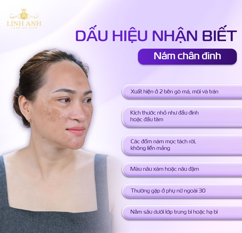 dấu hiệu bị nám chân đinh
