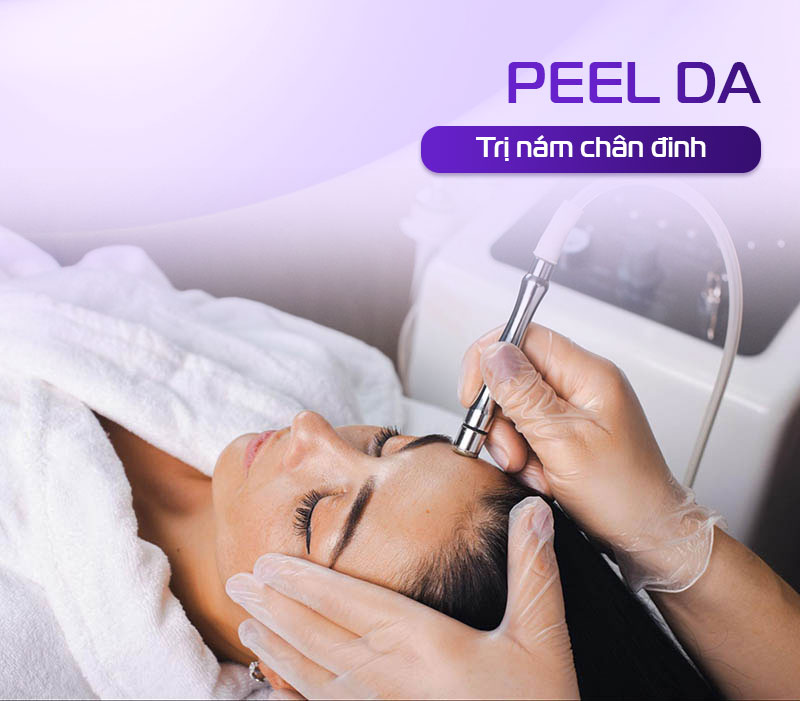 peel da trị nám