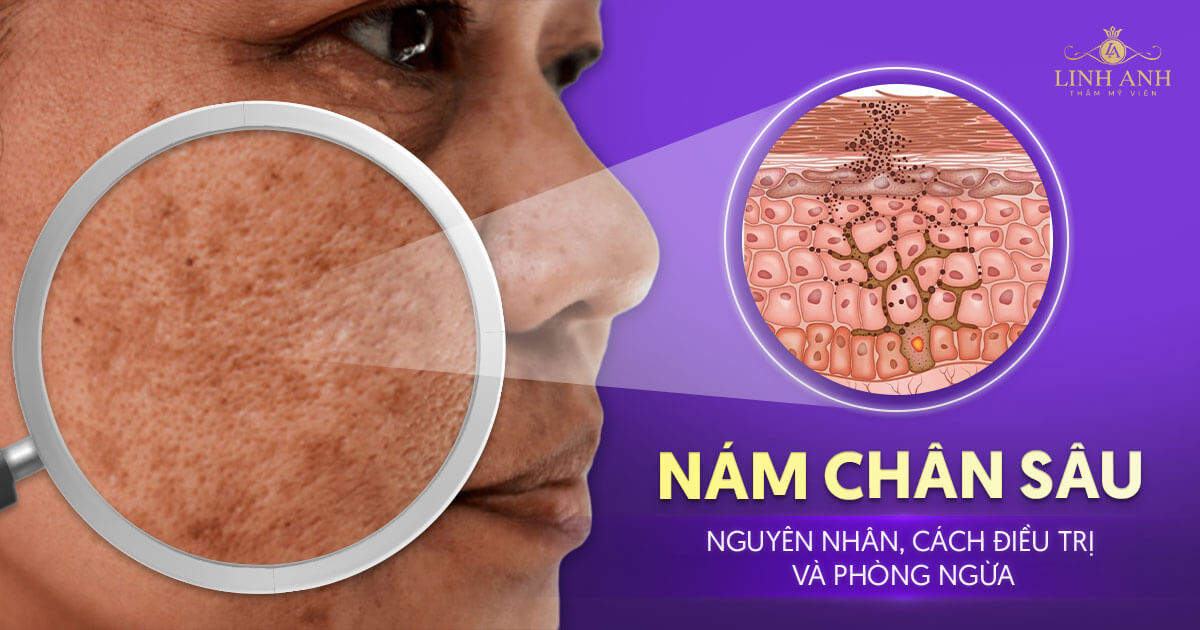Nám chân sâu là gì? Nguyên nhân, cách điều trị và phòng ngừa 