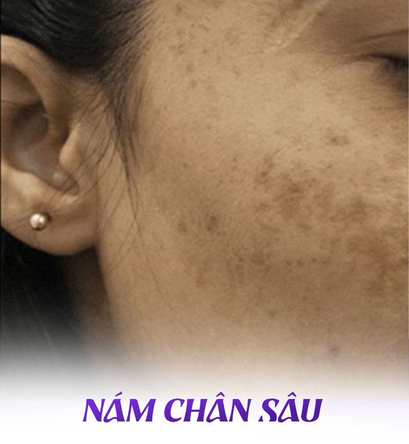Hình ảnh nám chân sâu
