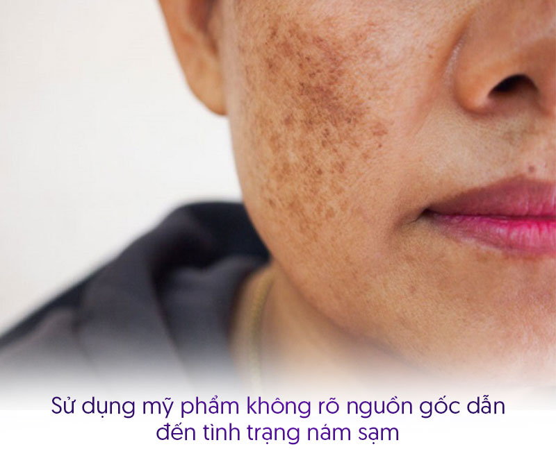 Nám chân sâu do mỹ phẩm không rõ nguồn gốc