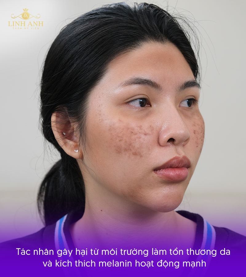 Da bị nám chân sâu do đâu