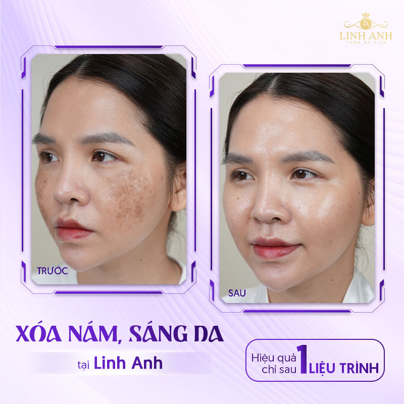 Trị nám chân sâu tại Linh Anh