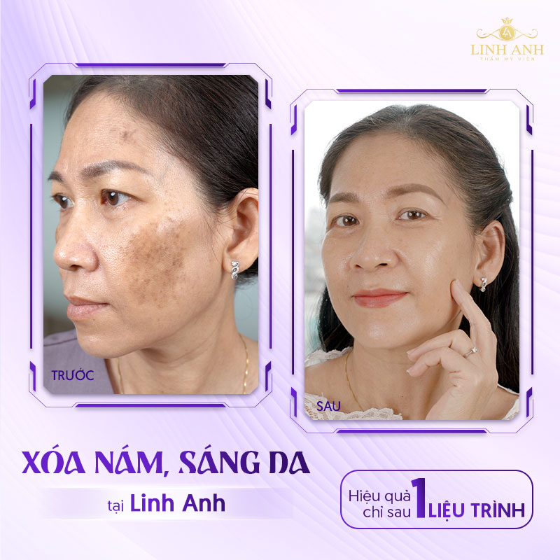 Khách hàng trị nám chân sâu tại Linh Anh