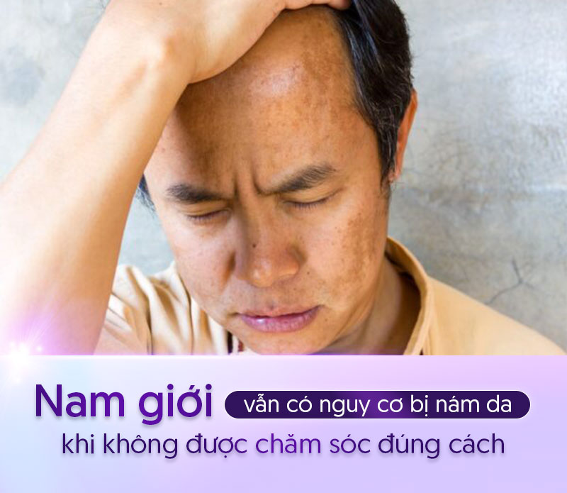 Nám da ở nam giới là gì