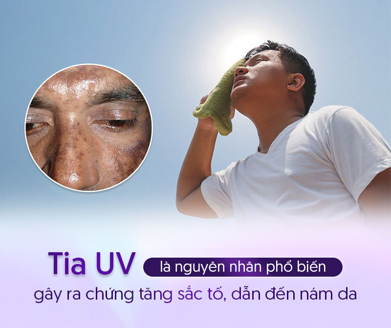 Nguyên nhân bị nám da ở nam giới