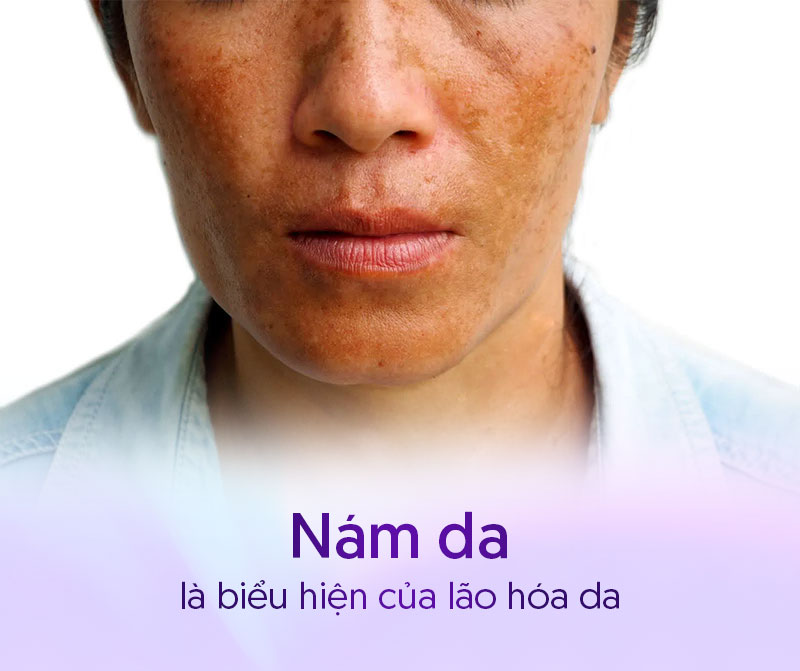Lão hóa gây nám da ở nam giới