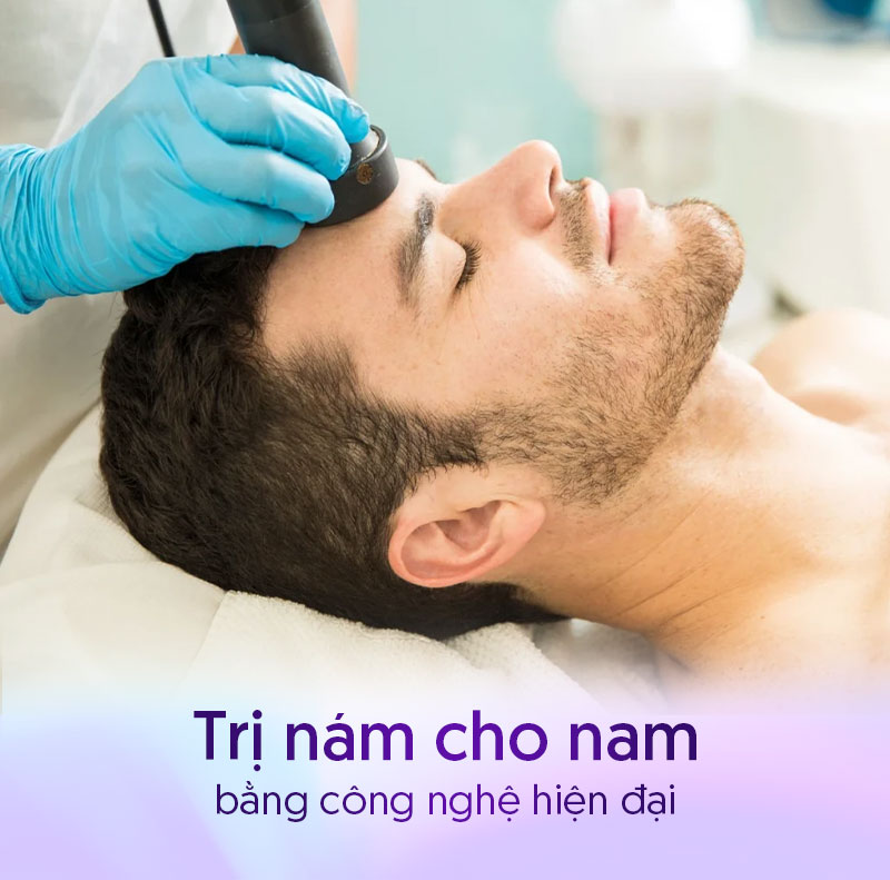 Công nghệ trị nám da mặt cho nam giới