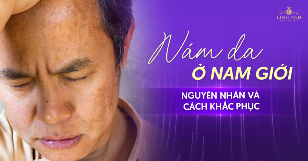 Nám da ở nam giới