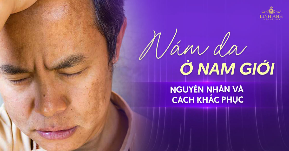 Nám da ở nam giới: Nguyên nhân, cách điều trị và lưu ý nên biết 