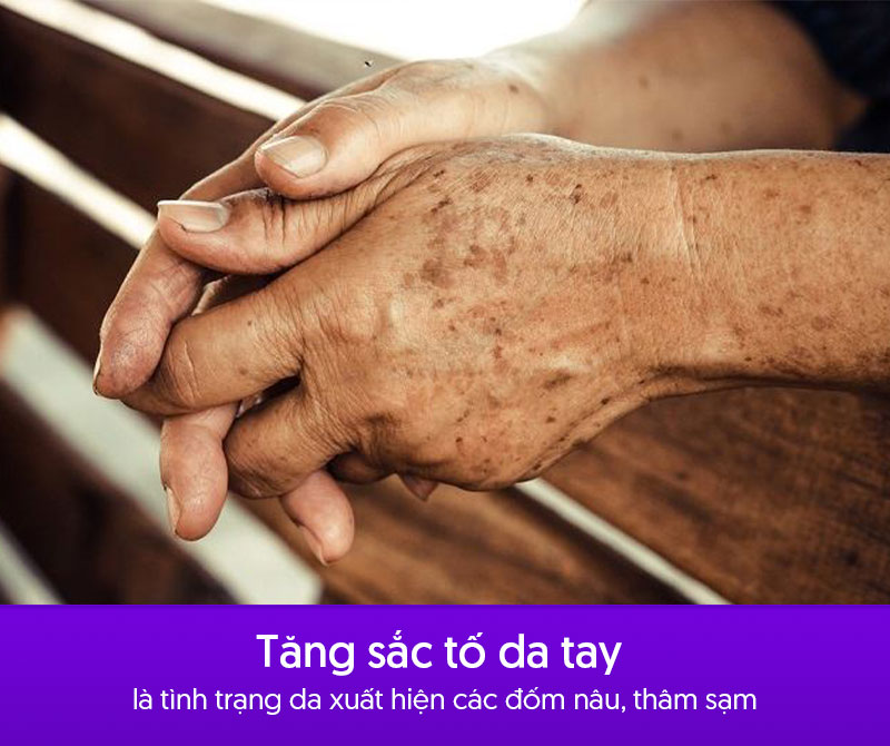 Bị nám ở tay là tình trạng gì