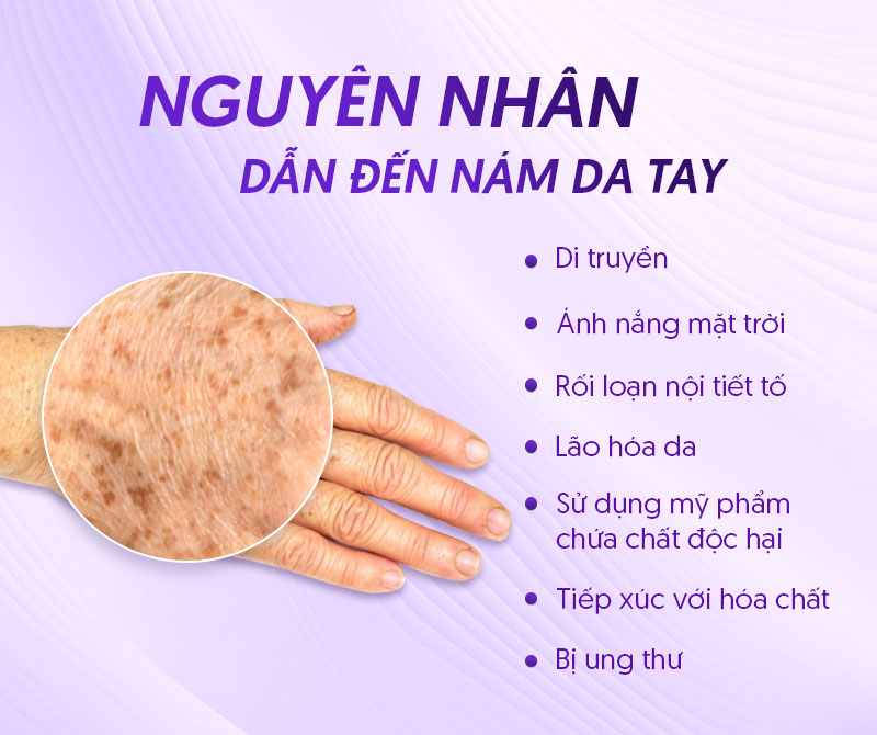 Da tay bị nám do đâu