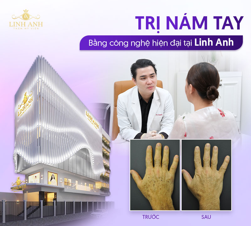 Trị nám tay tại Linh Anh