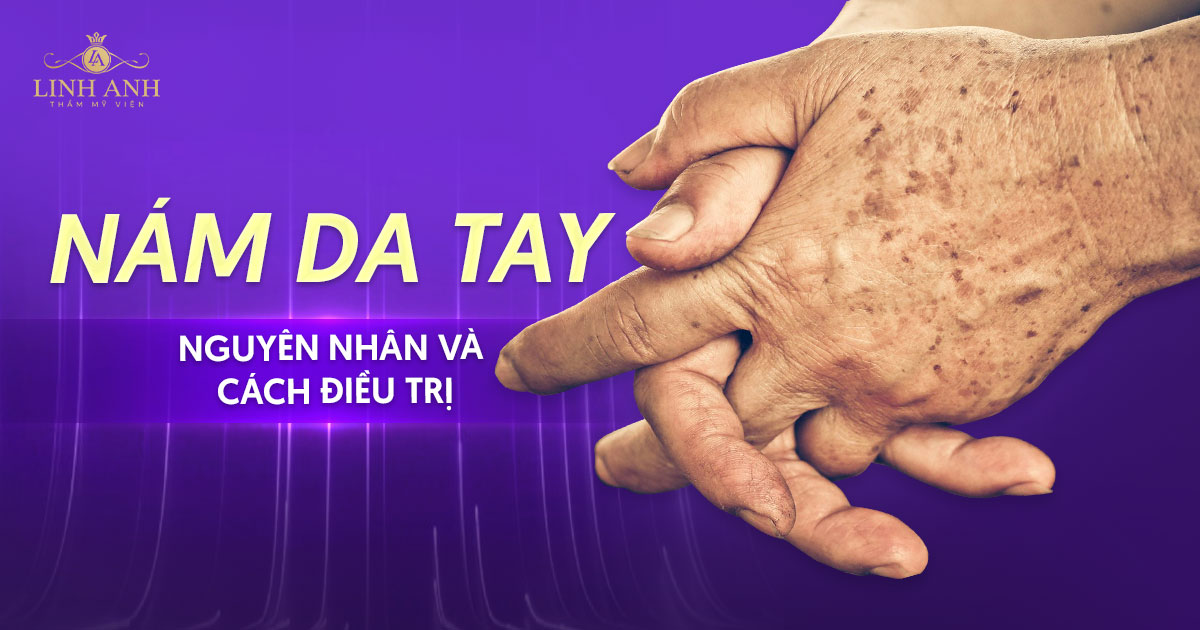 Nám da tay: Tìm hiểu nguyên nhân và cách điều trị hiệu quả