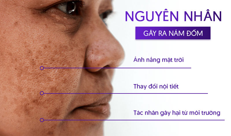 ngyên nhân bị nám đốm