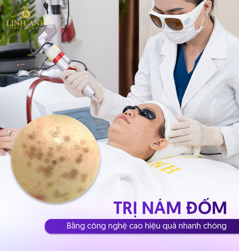 trị nám đốm