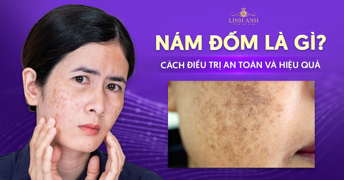 Nám đốm là gì? Cách điều trị nám đốm an toàn và hiệu quả