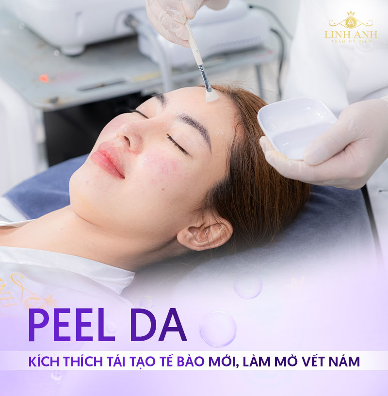 Peel da trị nám hỗn hợp