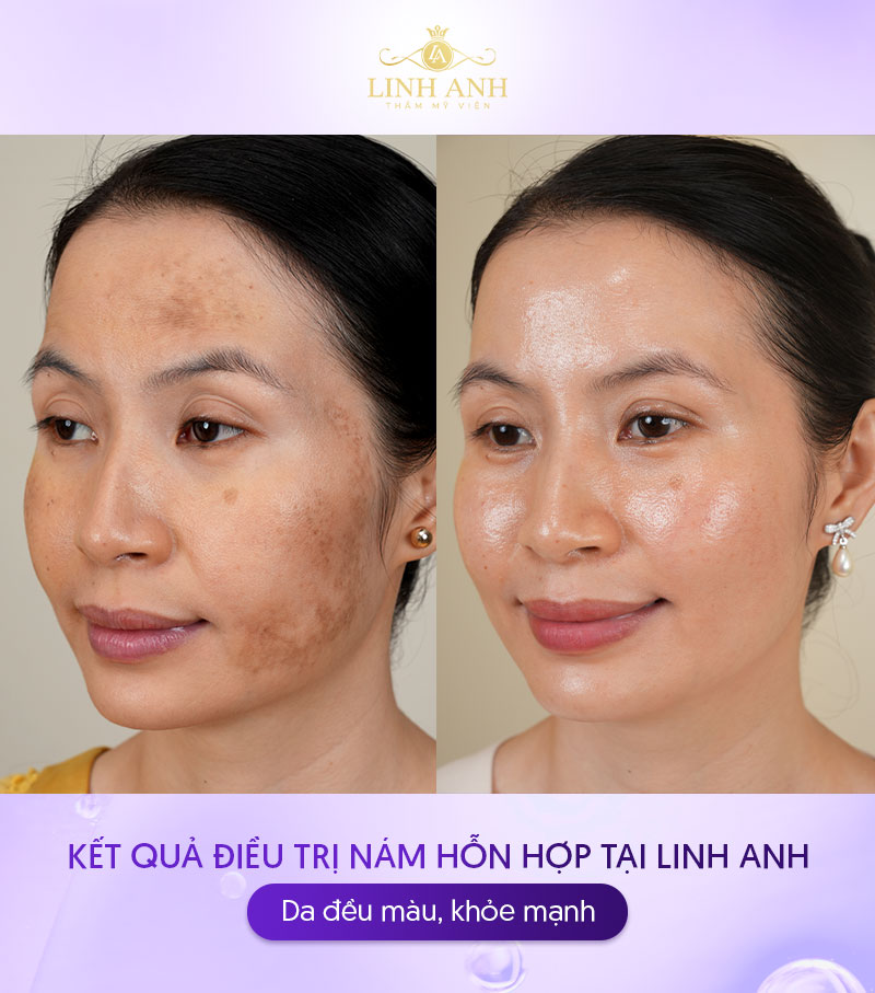 Điều trị nám hỗn hợp tại Linh Anh