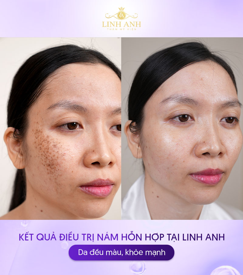 Trị nám hỗn hợp bằng công nghệ cao