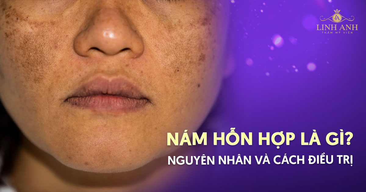Nám hỗn hợp là gì? Nguyên nhân & cách điều trị an toàn, hiệu quả