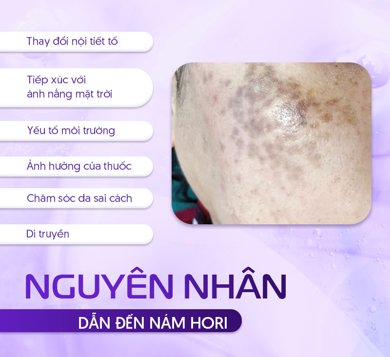 Nguyên nhân gây nám hori