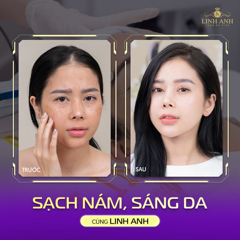Điều trị nám tại Linh Anh